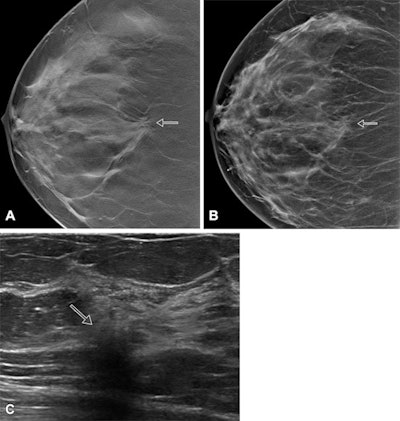 Images show screen-detected invasive breast cancer in dense breast tissue in a 65-year-old woman. The histology was invasive carcinoma of no special type with a tumor size of 10 mm, grade 2. (A) A single section of a DBT scan of the craniocaudal view of the right breast shows a cancer-related spiculated mass with highly suspicious radiologic features (arrow). (B) Corresponding synthesized mammogram of the right craniocaudal view shows that the cancer-related spiculation is less obvious in comparison to the single section (arrow). (C) Correlating ultrasound scan shows the invasive breast cancer as an irregular, indistinct, not parallel, hypoechoic mass (arrow) with a hyperechoic distortion of the adjacent parenchyma. Images courtesy of RSNA.