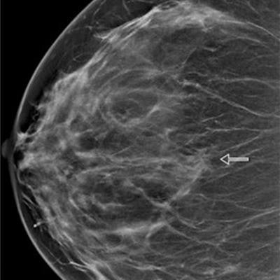 Dense breast tissue, what you need to know - Mayo Clinic Health System