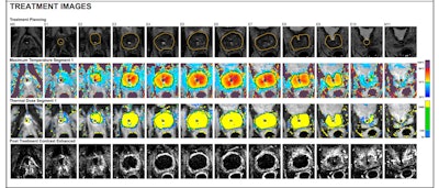 The aim of the MRI-guided transurethral ultrasound therapy system treatment report (TULSA-Pro) is to ablate the prostate tissue of patients with localized, organ-confined cancer. Figure courtesy of Prof. Afshin Gangi.