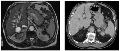 On two scans taken six months apart, a pancreatic tumor (stage IVB) was missed. On the MRI for renal cancer restaging six months prior, the lesion in the tip of the pancreatic tail was small and visible in retrospect only. Figure courtesy of Dr. Nosheen Umar.