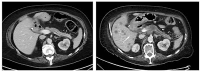 On two scans taken six months apart, a pancreatic tumor (stage IIIA) was missed, with the lesion being visible on review. Low attenuation area proximal body and minimal pancreatic duct dilatation distally were not reported. Figure courtesy of Dr. Nosheen Umar.