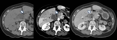 The tumor is not visible on either the precontrast scan or in the portal venous phase. It is only visible as a hypovascular mass on the later arterial phase. This technique is important when looking for pancreatic cancer. Courtesy of Dr. Alexandre Pérez Girbes, La Fe University and Polytechnic Hospital, Valencia, Spain.