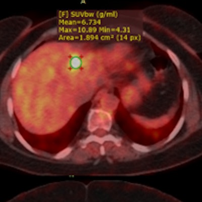 2022 10 11 21 49 4449 2022 10 12 Pet Ct Of Non Small Cell Lung Cancer 400