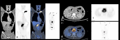 A 57-year-old woman with monoclonal gammopathy of undetermined significance. Progression to multiple myeloma was suspected. PET/CT confirmed the diagnosis by showing pathological uptake of FDG in the humerus and vertebra. All figures courtesy of Dr. Patricia García, Dr. Victor Rodríguez Laval, et al, presented at ECR 2022.