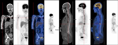 A 26-year-old man with fever and night sweats. Coronal CT (A), PET (B), and fusion (C) images show intense uptake of FDG in the left clavicle. CT (D), PET (E), and fusion (F) images show intense uptake of FDG of a mass next to the pancreas. The biopsy was compatible with Burkitt lymphoma (non-Hodgkin's lymphoma).