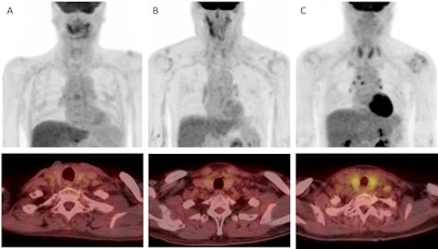 Examples of thyroid visual grade in the study cohort (upper: maximum intensity projection, lower: transaxial view). A) In grade 1, thyroid uptake is less than blood pool uptake. B) In grade 2, thyroid uptake is equal to or higher than blood pool uptake, but less than liver uptake. C) In grade 3, thyroid uptake is equal to or higher than liver uptake. Image courtesy of Cancer Imaging.