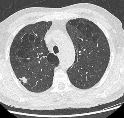 Low-dose injection-free thoracic CT scan of a 68-year-old man that was performed as part of the screening program (Prevalung study). After the workup, the patient was operated on, revealing a 14 mm adenocarcinoma classified pT1bN0M0. He is now under simple surveillance. Courtesy of Dr. Caroline Caramella and SFR and SIT.