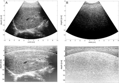 (Left) Calibrated ultrasound software shows a normal liver. (Right) Images show nonalcoholic fatty liver disease on an activity score grade-3 liver. Images A and B show original B-mode images with applied lookup table correction. Images C and D are back-scanned images with applied post-processing steps. These steps included automatic gain correction, superficial tissue layer correction, automatic segmentation, and residual attenuation correction. Images courtesy of the RSNA.