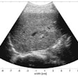 2022 10 26 05 15 7254 2022 10 18 Radiology Weijers Ultrasound Liver Staging 20221026050347