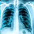 2017 12 01 19 18 0879 X Ray Chest Lungs 400