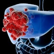2019 10 30 17 20 3763 Liver Cancer 400