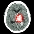 2020 06 02 23 08 0038 Ct Brain Stroke 400