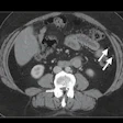 2022 05 12 14 52 6515 2022 05 11 Ismrm Mri Ct Ovarian Cancer 400