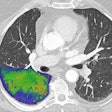 2022 09 26 20 11 1920 2022 09 27 Lung Covid Phonton Counting 20220926203021