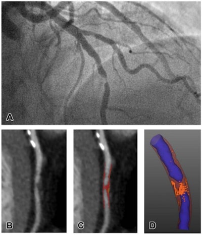 Representative images of CT plaque analysis demonstrate differences between type 1 and type 2 myocardial infarction. (Left panel) Images in a 42-year-old man diagnosed with type 1 myocardial infarction. (A) Image from invasive angiography demonstrates severe stenosis in the distal left anterior descending artery. (B) CT coronary angiogram, curved planar reformation, (C) quantitative plaque analysis, and (D) three-dimensional quantitative plaque analysis demonstrate a high burden of low-attenuation plaque. Right panel: Images in a 74-year-old man diagnosed with type 2 myocardial infarction. Images courtesy of the RSNA.