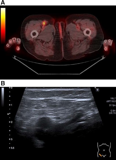 Lymph node metastasis inguinal right. (A) Detected as true positive by F-18 FDG-PET/CT. (B) Not evaluated as lymph node by ultrasound (false negative). Image courtesy of Medicine.