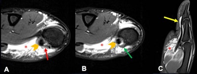 Thumb pulley injury. A 17-year-old male goalkeeper with pain after trauma on the thumb. (A, B) axial and (C) sagittal T2-weighted fat-suppressed images show thickening and irregularity of the A1 pulley (red arrow) and annular pulley or Av pulley (green arrow). Tenosynovitis of the flexor pollicis longus is visible (yellow arrow) with tendon integrity (orange chevron). Moderate diffused edema of the thenar muscles, surrounded with some fluid, related to the contusion (red asterisks), is also demonstrated.