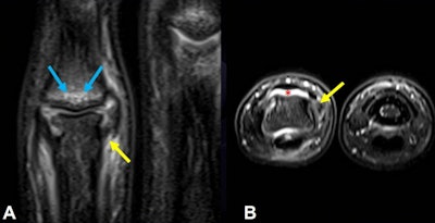 Partial tear of the collateral ligament following trauma during football training in a 15-year-old male goalkeeper with left finger pain. (A) coronal and (B) axial T2-weighted fat-suppressed images show partial tear at the origin of the radial collateral ligament at the level of the proximal interphalangeal (PIP) joint of the fifth finger with diffuse ligament thickening (yellow arrows). There is bone contusion at middle phalanx (blue arrow) and PIP joint effusion (red asterisk). All figures courtesy of Dr. Tatiane Cantarelli and colleagues and presented at ISS 2022 in Barcelona.