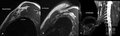 A 34-year-old man with a clinical picture consistent with NTOS. MR images (T1-weighted sagittal) show a capacious costoclavicular space (CS) in the neutral position measuring 24 mm at the narrowest point. With the arm elevated, this reduced markedly to a minimal distance of 4 mm, with the brachial plexus interposed between the clavicle (C) and first rib (R) at this point. Flattening of the subclavian vein (SV) was also demonstrated. No variant anatomy or other cause for compression was seen either radiographically or surgically. (A) Sagittal oblique T1-weighted image at the level of the CS in the neutral position. The CS measures 24 mm in the neutral position, and the divisions of the brachial plexus are clearly outlined by fat (arrows). S = subclavius muscle, SA = subclavian artery. (B) Sagittal oblique T1-weighted image at the level of the CS, arm abducted. The CS is narrowed to 4 mm at the point of the brachial plexus. Arrows = divisions of the brachial plexus. (C) T2 3D SPACE STIR thick MIP reconstruction in coronal plane, level of CS, arm abducted. The CS is narrowed to 4 mm. C5 - T1 nerve roots = labelled. The patient underwent resection of the right first rib with good clinical response. All figures courtesy of Dr. Liam Pugh and Dr. Thomas Lloyd, presented at RANZCR ASM 2022.