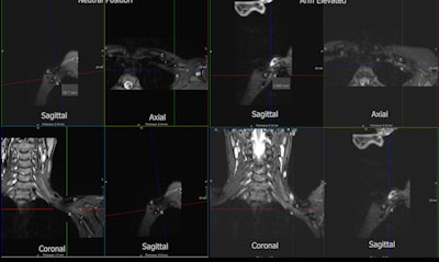 A 49-year-old woman with prolonged symptoms of NTOS, including neck, chest, upper back and upper limb pain, paresthesia, muscle weakness, and muscular atrophy. MRI demonstrated significant narrowing of the costoclavicular space (CS) with the arm elevated narrowing from 26 mm to 5 mm. The patient underwent decompressive surgery with first rib resection and anterior and middle scalenectomy with thoracic outlet syndrome confirmed with the presence of extensive scar tissue surrounding the brachial plexus. Fibromuscular bands between the anterior and middle scalene muscles were also identified. The patient had clinical improvement, but not entire resolution of symptoms, which could relate to the duration of the compression prior to release. (A) T2 3D SPACE STIR 3 planes. Level of CS in neutral position. C = clavicle, R = first rib, A = subclavian artery, V = subclavian vein, CS = measured (26 mm). (B) T2 3D SPACE STIR 3 planes. Level of CS with the arm abducted. The CS is again significantly narrowed to 5 mm.