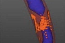 2022 11 02 21 15 8633 2022 10 31 Ctca Heart Attack Figure4 20221102211559