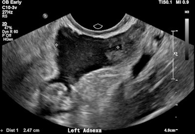 Pelvic free fluid with low-level internal echoes consistent with hemoperitoneum.
