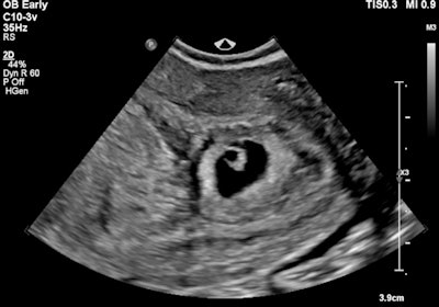 Intrauterine gestational sac with fetal pole. All images courtesy of Dr. Jeffrey Alexis and Dr. Patricia Deonarine, presented at RANZCR ASM 2022.