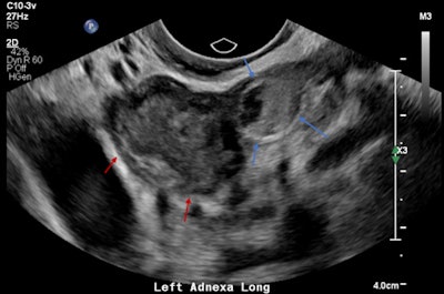 Left adnexal heterogeneous mass with an echogenic tubal ring sign (blue arrows) adjacent to the left ovary (red arrows).