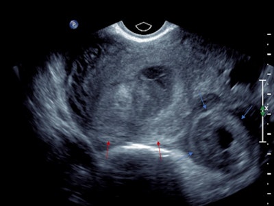 Transvaginal ultrasound in transverse orientation. The left adnexal mass demonstrates a hyperechoic tubal ring sign (blue arrows). The uterus (red arrows) demonstrates a double decidual reaction.