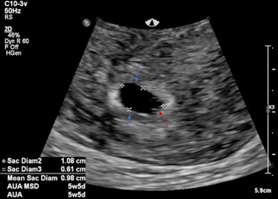 Intrauterine gestational sac (blue arrows) and yolk sac (red arrow). No fetal pole identified.