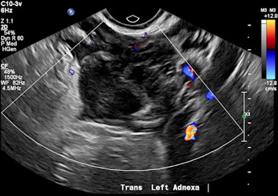 Avascular left adnexal heterogeneous mass.