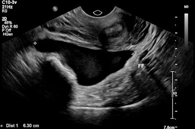 Moderate free fluid with low level echoes within the pouch of Douglas consistent with hemoperitoneum.