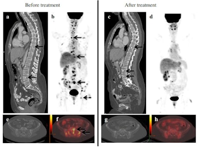 86-year-old woman with metastatic breast cancer before and after first-line endocrine therapy combined with bevacizumab shows stable disease by contrast-enhanced CT and complete response by PET/CT. CT images demonstrate several sclerotic foci in the spine, representing biopsy-proven osseous metastases (arrows in a), with no discernible change after treatment (c). Imaging shows multiple FDG-avid metastases, including the spine (short arrows), pelvis (dashed arrow), and ribs (dotted arrow) (b), with resolution after treatment initiation (d). Axial CT image of the pelvis in the same patient showing no metastases before (e) and after therapy (g). Corresponding axial PET/CT image shows multiple metastases before (f) and resolution of uptake after treatment (h). The patient was still alive at a follow-up of 47 months. Figure courtesy of Drs. Christopher Riedl, Katja Pinker, et al, originally published in EJNMMI.