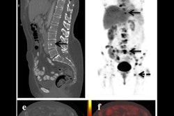 2022 11 15 16 29 6304 2022 11 15 Ejnmmi Riedl Breast Pet Ct Figure2 400