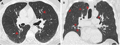 CT images show airway changes in a 66-year-old male marijuana and tobacco smoker. Contrast-enhanced (A) axial and (B) coronal images show cylindrical bronchiectasis and bronchial wall thickening (arrowheads) in multiple lung lobes bilaterally in a background of paraseptal (arrows) and centrilobular emphysema. Images courtesy of RSNA.