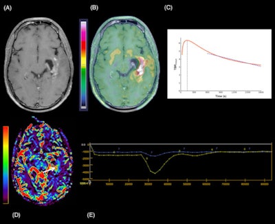 A 24-year-old man with a suspected GIII anaplastic astrocytoma IDH-mutant recurrence, referred for a PET/MRI. 3D Fat-saturated T1 with gadolinium sequence (A) shows enhanced lesions along the left temporal horn. Fused PET/MRI (B) highlights the high F-18 fluorodopa (FDOPA) uptake by the lesions (TBRmean = 2.3; TBRmax = 4.7; TSRmean = 1.2; TSRmax = 2.5; metabolic tumor volume = 29.71 cm3). The dynamic curve shows a washout pattern (slope = −5.42 h-1) (c, slope dark blue dotted line). Axial CBV reveals more voluminous areas (white arrow) that correspond to increased tumor angiogenesis (yellow line: lesion, blue line: contralateral normal brain parenchyma) (D, E). Follow-up MRI one month after the PET/MRI, confirms progression according to the Response Assessment in Neuro-Oncology (RANO) criteria. Figure courtesy of Dr. Laura Rozenblum et al, and European Radiology.