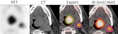 A successful segmentation by AI of head and neck tumor lesions from PET/CT images. The AI segmentation is almost identical to that of an expert. Courtesy of Thibault Escobar, doctoral candidate, Laboratory of Translational Imaging in Oncology (LITO), Institute Curie, Paris.