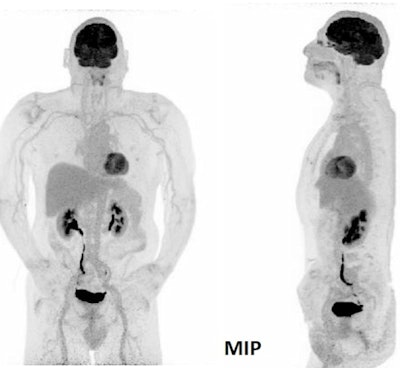 Ultralow-dose scan on Biograph Vision Quadra PET/CT (F-18 FDG in a healthy volunteer; weight: 86 kg; dose: 20.8 MBq [0.24 MBq/kg]).