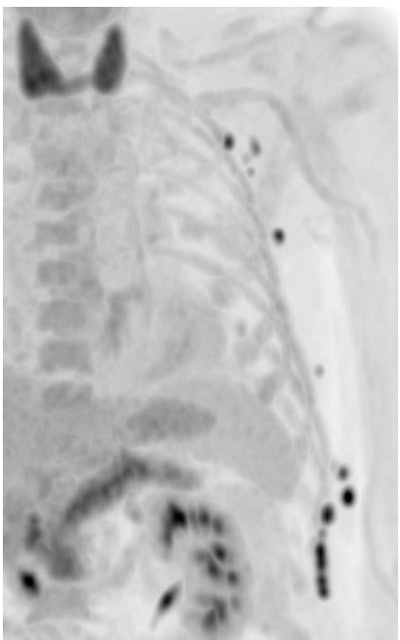 PET in a patient with lymph node metastatic disease from malignant melanoma. Tiny hypermetabolic lymph nodes detected in a two-minute scan (Biograph Vision Quadra PET/CT from Siemens, 120 min. p.i., 220 MBq FDG). All images courtesy of Prof. Dr. Axel Rominger.