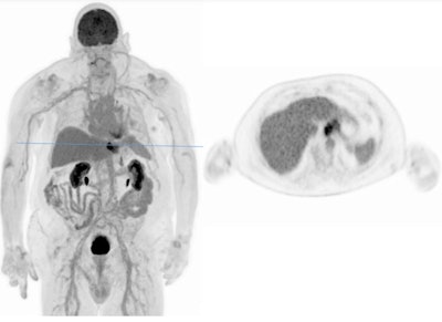 Non-optimal conditions with elevated blood glucose level and obesity (adenocarcinoma AEG, BG: 12.3 mmol/l, BMI 32kg/m2, 3 MBq/kg FDG, 60 min p.i, 6 min acquisition).
