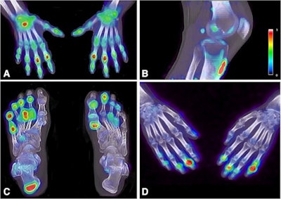 F-18 NaF enhancement in the right wrist and proximal interphalangeal joints of the hands (A), at the patella tendon insertion (B), in the metatarsophalangeal and interphalangeal joints of the feet and the right Achilles tendon (C), and in the distal interphalangeal joints of the hands (D). Image courtesy of the European Journal of Nuclear Medicine and Molecular Imaging.