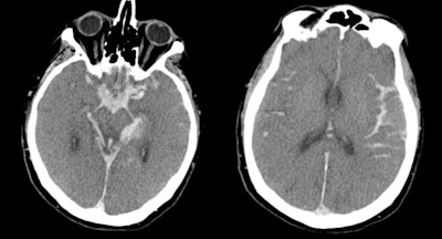 CT images show catastrophic subarachnoid hemorrhage. All images courtesy of Dr. Lenetta Boyce.