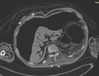 CT image shows severe decomposition of the abdomen.