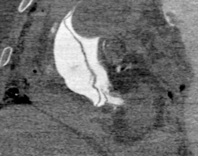 CT image shows type A aortic dissection.