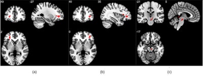 Group analysis on susceptibility-weighted imaging exhibiting higher susceptibility-weighted imaging values in the COVID group when compared to healthy controls. Three significant clusters were found primarily in the white matter regions of the prefrontal cortex and in the brainstem. The clusters (A) and (B) are observed bilaterally in the cerebral white matter near the orbitofrontal gyrus, whereas (C) lies in the midbrain region. Figure courtesy of RSNA and Sapna Mishra.
