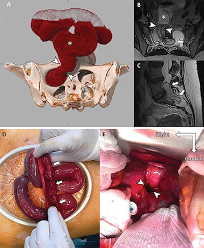 Images of a 38-year-old woman with Marfan syndrome who was diagnosed with intradural small bowel herniation through a torn right S1 dural ectasia. (A) Oblique global illumination rendering of abdominal CT scan after semiautomatic segmentation of the enlarged afferent small bowel (*). The hernia orifice (arrowheads) separates the peritoneal cavity and the intradural space. (B, C) T2-weighted MRI scans in (B) axial and (C) sagittal planes show the herniated loop (arrowheads in B) of small bowel (* in B) ascending at L5-S1 (arrows), causing significant compression of the adjacent cauda equina nerve roots. All figures courtesy of Radiology.