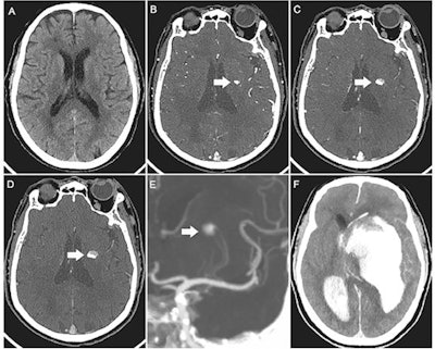Images of a 73-year-old man with acute left-sided weakness. (A) Axial noncontrast CT image of the head shows no intracerebral hemorrhage. (B) Arterial phase CT angiogram obtained 192 seconds later, after administration of contrast material, demonstrates focal enhancement in the left basal ganglia (arrow). (C, D) CT angiograms obtained in the (C) second and (D) third phases, with delays of 39 seconds and 38 seconds, respectively, highlight the active expansion of the intracerebral hemorrhage with the blood-contrast level (arrows). (E) Coronal maximum intensity projection image reveals that the bleeding was located near the distal ends of the lenticulostriate arteries (arrow). (F) Follow-up noncontrast CT image obtained 1 hour after the third phase CT angiogram shows massive enlargement of the hematoma, intraventricular hemorrhage, hydrocephalus, and subfalcine herniation.