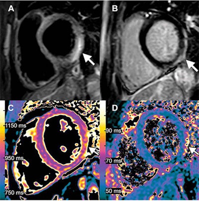 Images of a 15-year-old boy with myocarditis after COVID-19 vaccination. One day after receiving his second vaccination dose, he developed fever, myalgia, and intermittent tachycardia. (A) T2-weighted short inversion time inversion recovery MRI scan at 1.5 T in short-axis view shows focal high-signal intensities (arrow) at basal lateral and inferior wall, indicating myocardial edema. (B) Late gadolinium enhancement image in short-axis view shows corresponding linear subepicardial enhancement (arrow), indicating inflammatory myocardial necrosis. (C) T1 mapping and (D) T2 mapping in short-axis view show elevated T1 and T2 at the midventricular lateral and inferolateral wall (arrow in C and D), indicating acute myocardial injury (focal T1, 1165 msec; focal T2, 70 msec; institution-specific cutoff values for acute myocarditis: T1 global ≥1000 msec, T2 global ≥55.9 msec).