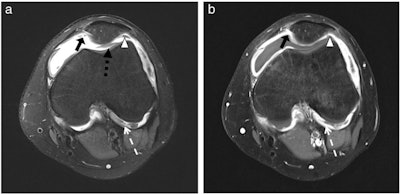 A 12-year-old girl with extended oligoarthritis. Axial images demonstrate joint effusion and synovial membrane thickening, notably at the junction of the lateral condyle and the cruciate ligament (white dotted arrow), medial (black arrow), lateral (white arrowhead), and dorsal (black dotted arrow) to the patella, notably visible on image. (A) Proton-density-weighted fat-saturated sequence. (B) Contrast-enhanced T1-weighted turbo spin echo fat-saturated sequence. Figure courtesy of Dr. Van Dai Vo Chieu et al and European Radiology.