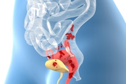 2022 12 09 04 20 7679 Endometriosis 3 D Illustration 400